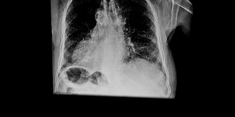 Peut On Vivre Longtemps Avec Un Anévrisme De L Aorte