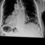 Une personne atteinte d'un anévrisme de l'aorte espérer vivre longtemps ?